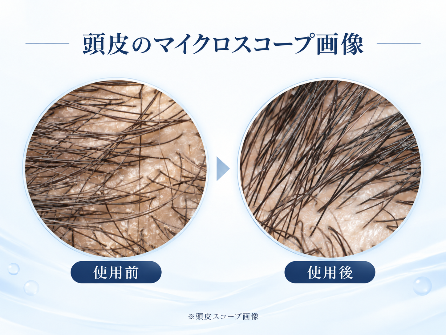 スカルプスチームキャップ使用前後の頭皮をマイクロスコープで確認